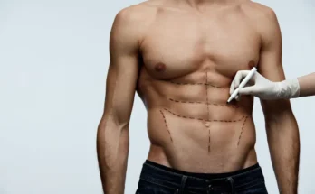 Extended Tummy Tuck Surgery