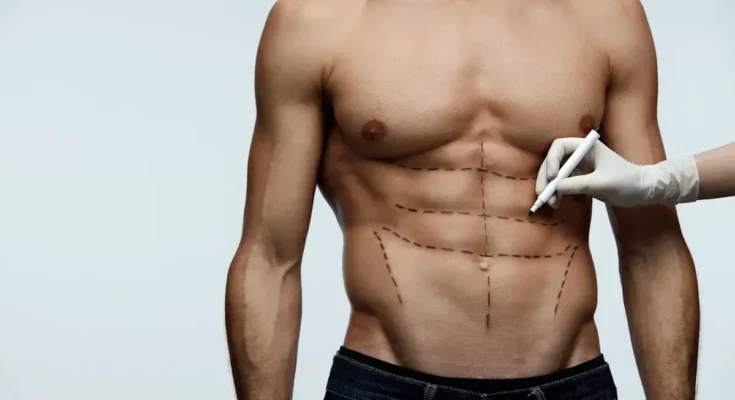 Extended Tummy Tuck Surgery