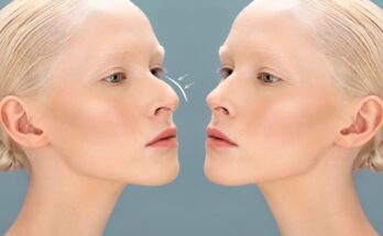 Dorsal Hump Removal Surgery