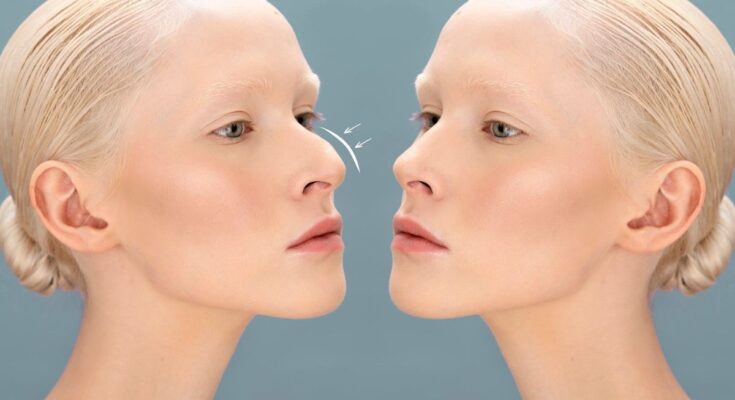 Dorsal Hump Removal Surgery